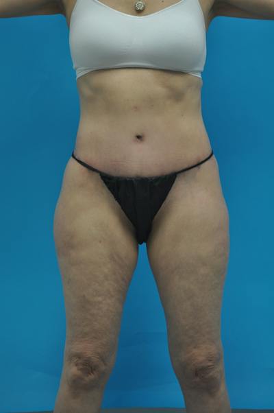 New Jersey Post Weight Loss Body Contouring Before & After Gallery - Patient 712281 - Image 2