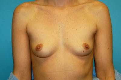 Breast Augmentation Before & After Gallery - Patient 8794877 - Image 1