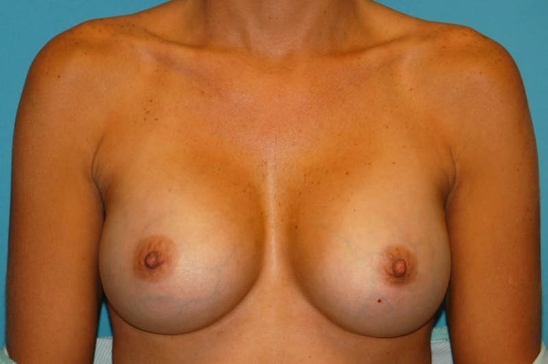 Breast Augmentation Before & After Gallery - Patient 8794877 - Image 2