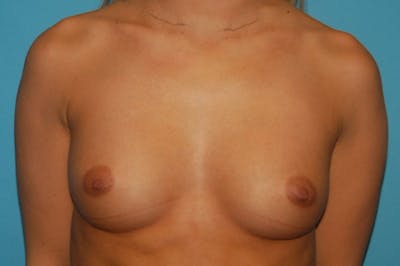 Breast Augmentation Before & After Gallery - Patient 8794909 - Image 1