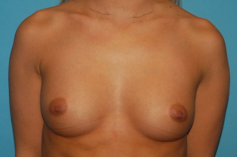 Breast Augmentation Before & After Gallery - Patient 8794909 - Image 1