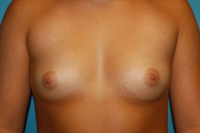 Breast Augmentation Before & After Gallery - Patient 8794913 - Image 1