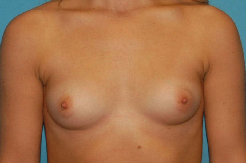 Breast Augmentation Before & After Gallery - Patient 8794914 - Image 1