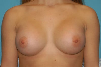 Breast Augmentation Before & After Gallery - Patient 8794914 - Image 2