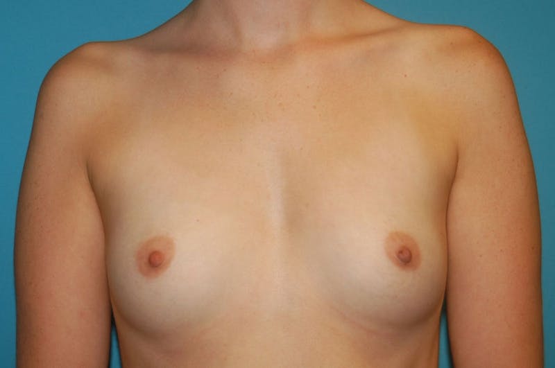 Breast Augmentation Before & After Gallery - Patient 8794915 - Image 1