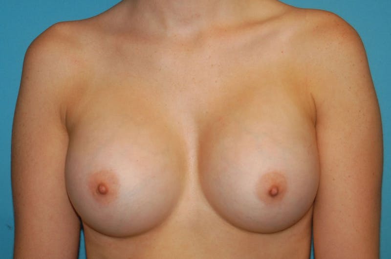 Breast Augmentation Before & After Gallery - Patient 8794915 - Image 2