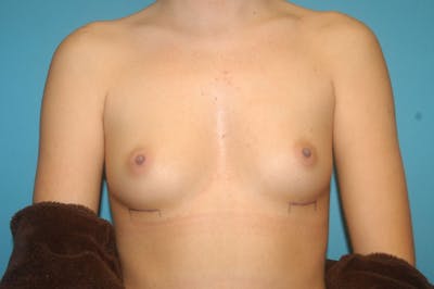 Breast Augmentation Before & After Gallery - Patient 8794943 - Image 1