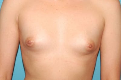 Breast Augmentation Before & After Gallery - Patient 8794944 - Image 1