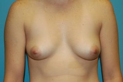 Breast Augmentation Before & After Gallery - Patient 8794945 - Image 1