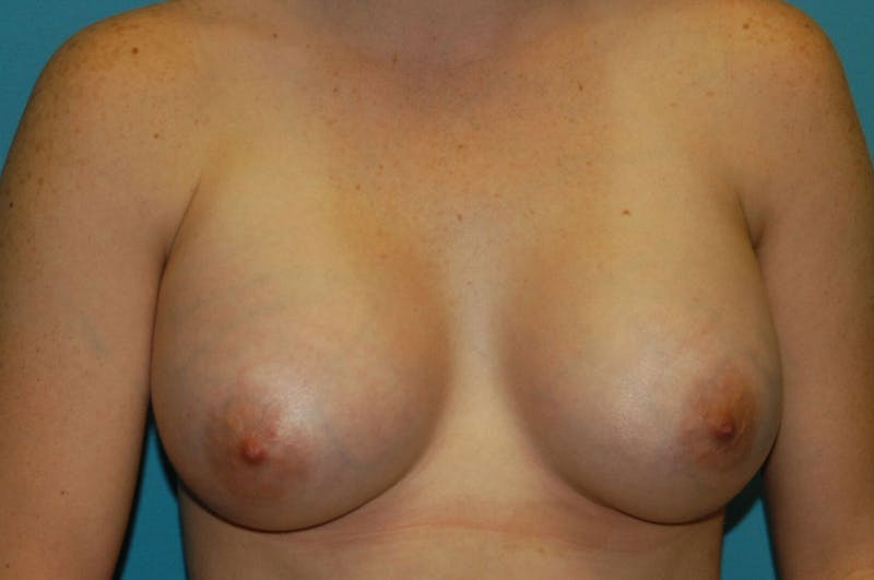 Breast Augmentation Before & After Gallery - Patient 8794945 - Image 2