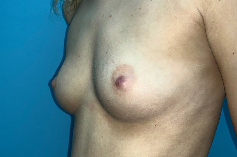 Breast Augmentation Before & After Gallery - Patient 8794946 - Image 3