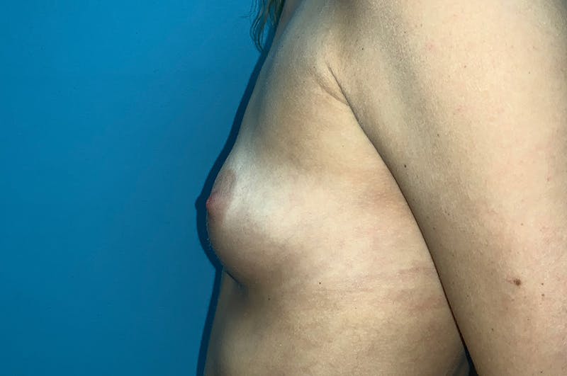 Breast Augmentation Before & After Gallery - Patient 8794946 - Image 5