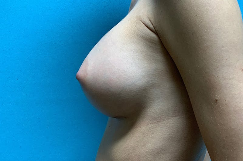 Breast Augmentation Before & After Gallery - Patient 8794946 - Image 6
