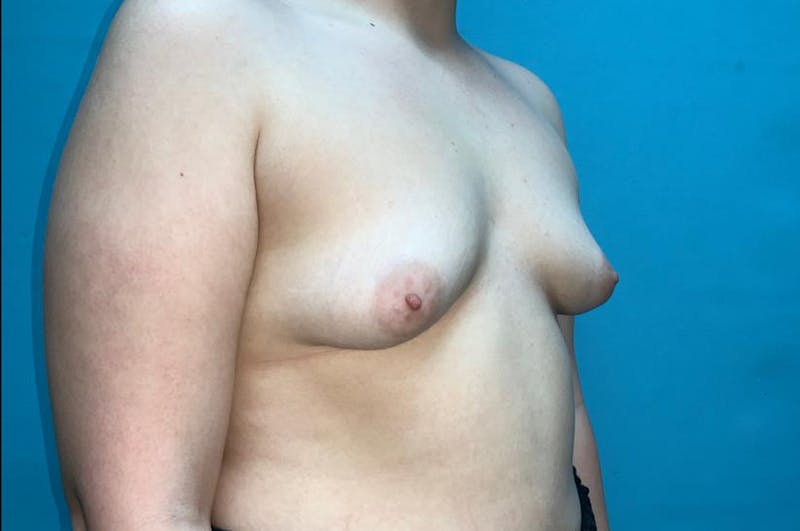 Breast Augmentation Before & After Gallery - Patient 8795061 - Image 3