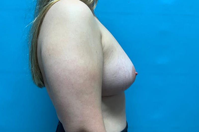 Breast Augmentation Before & After Gallery - Patient 8795061 - Image 6
