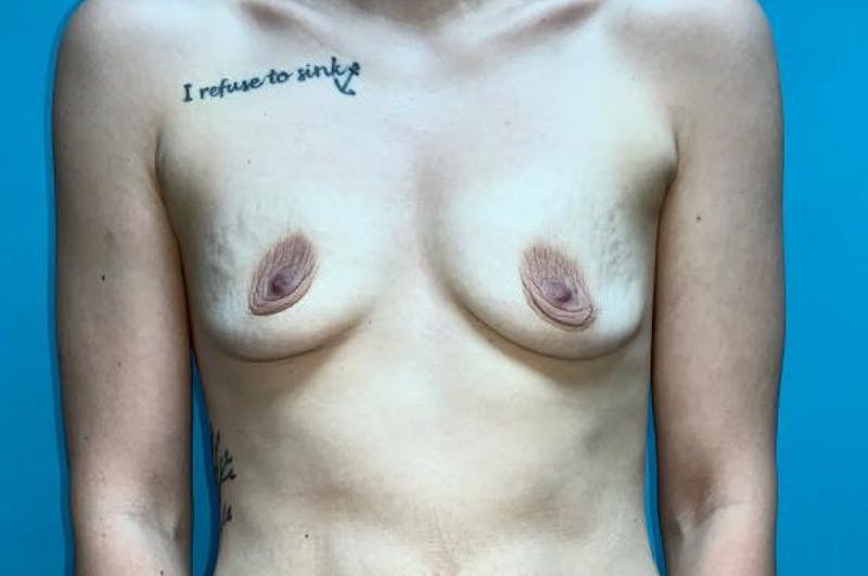 Breast Augmentation Before & After Gallery - Patient 8795085 - Image 1