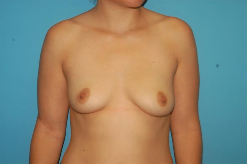 Breast Augmentation Before & After Gallery - Patient 8795086 - Image 1