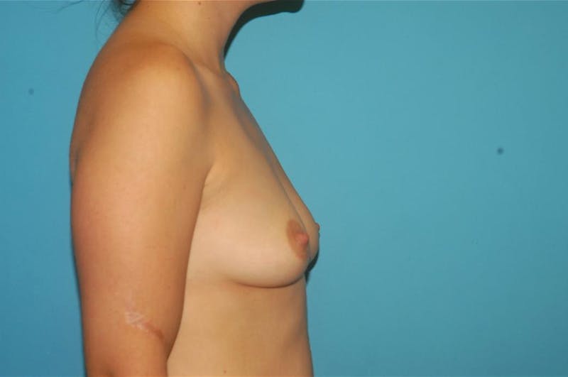 Breast Augmentation Before & After Gallery - Patient 8795086 - Image 3