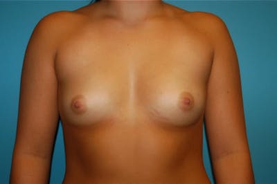 Breast Augmentation Before & After Gallery - Patient 8795088 - Image 1