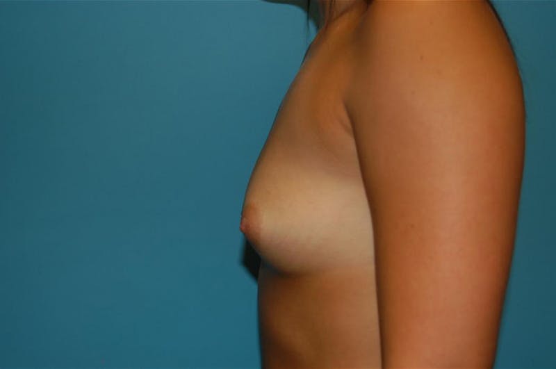 Breast Augmentation Before & After Gallery - Patient 8795088 - Image 3