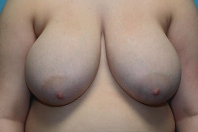 Breast Reduction Before & After Gallery - Patient 8795107 - Image 1