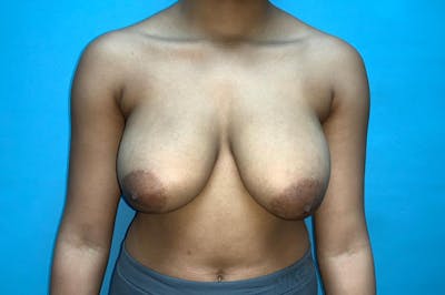 Breast Reduction Before & After Gallery - Patient 8795109 - Image 1