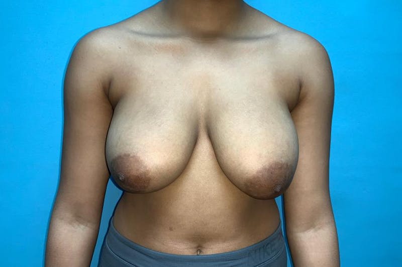Breast Reduction Before & After Gallery - Patient 8795109 - Image 1