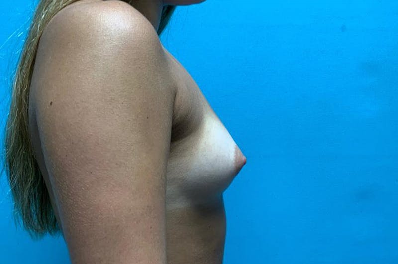 Breast Augmentation Before & After Gallery - Patient 8795110 - Image 5