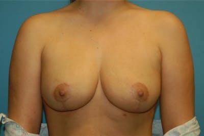 Breast Reduction Before & After Gallery - Patient 8795111 - Image 2