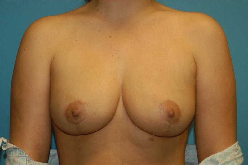 Breast Reduction Before & After Gallery - Patient 8795111 - Image 2