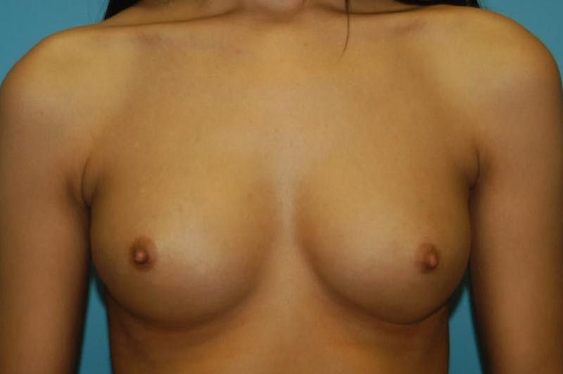 Breast Augmentation Before & After Gallery - Patient 8795137 - Image 1