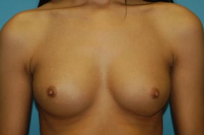 Breast Augmentation Before & After Gallery - Patient 8795137 - Image 1