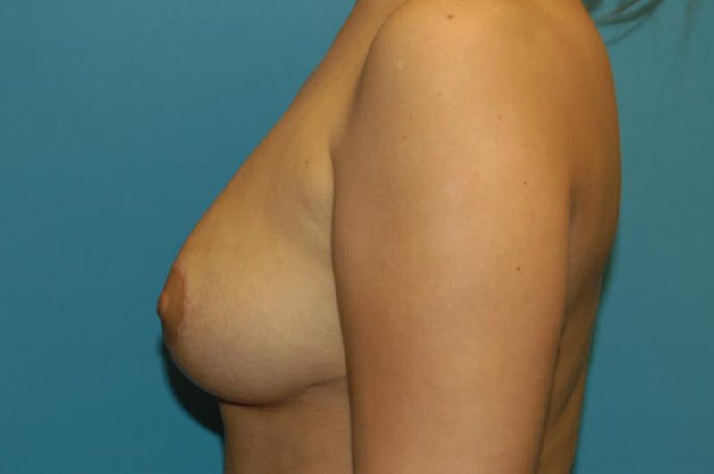 Breast Reduction Before & After Gallery - Patient 8795111 - Image 4