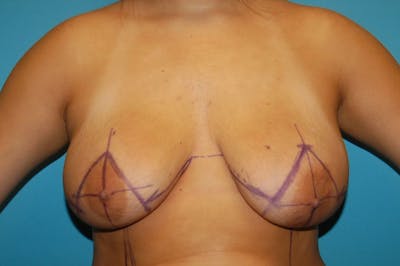 Mastopexy Before & After Gallery - Patient 8795112 - Image 1
