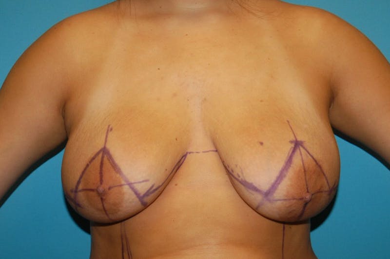 Mastopexy Before & After Gallery - Patient 8795112 - Image 1