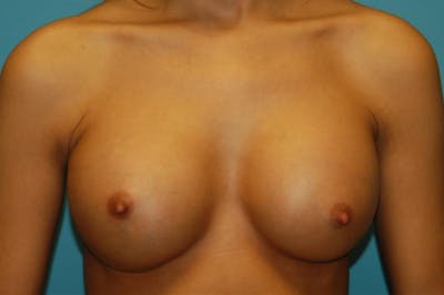 Breast Augmentation Before & After Gallery - Patient 8795137 - Image 2