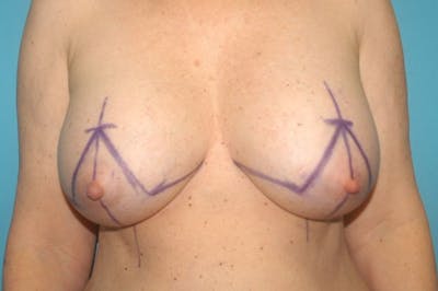 Mastopexy Before & After Gallery - Patient 8795135 - Image 1