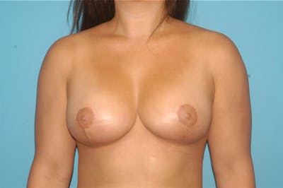 Breast Reduction Before & After Gallery - Patient 8795138 - Image 2
