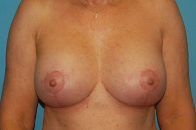 Mastopexy Before & After Gallery - Patient 8795135 - Image 2