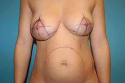 Mastopexy Before & After Gallery - Patient 8795136 - Image 1