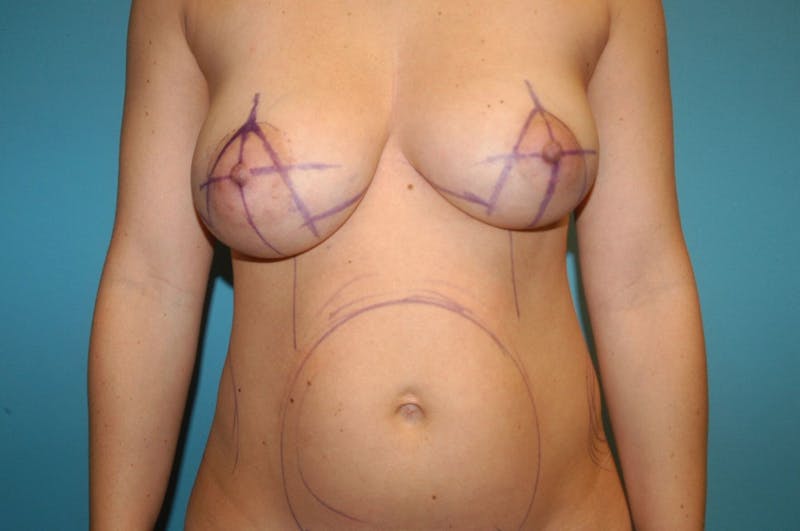 Mastopexy Before & After Gallery - Patient 8795136 - Image 1