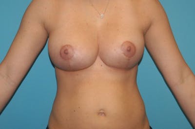 Mastopexy Before & After Gallery - Patient 8795136 - Image 2