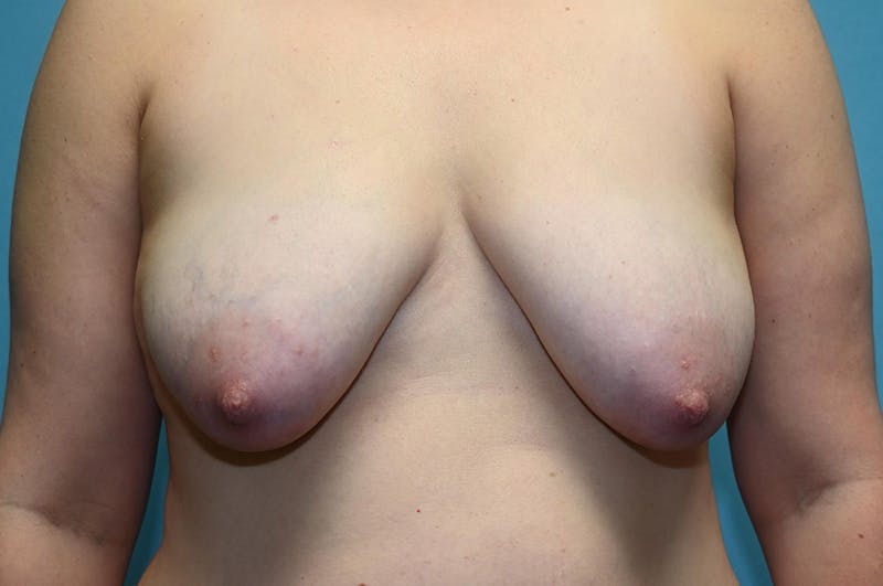 Mastopexy Before & After Gallery - Patient 8795139 - Image 1