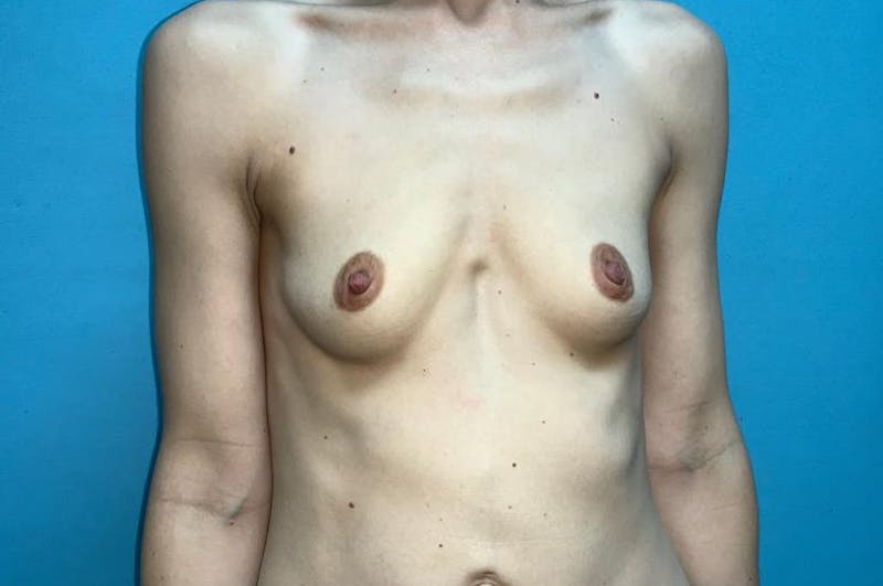 Breast Augmentation Before & After Gallery - Patient 8795140 - Image 1