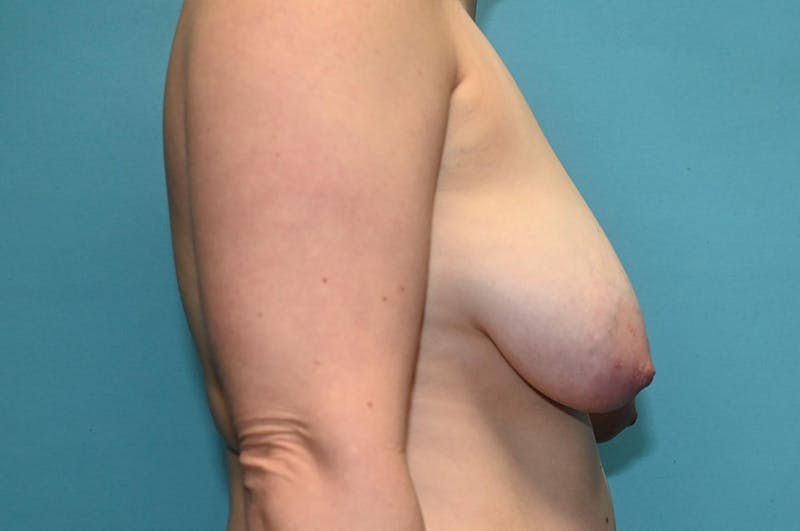 Mastopexy Before & After Gallery - Patient 8795139 - Image 5