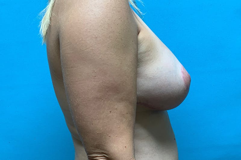 Mastopexy Before & After Gallery - Patient 8795139 - Image 6