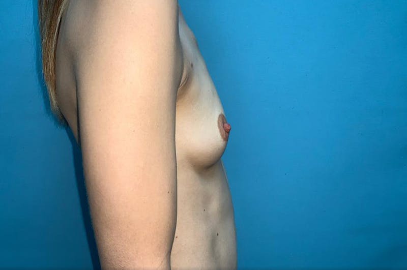 Breast Augmentation Before & After Gallery - Patient 8795140 - Image 5