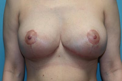 Mastopexy Before & After Gallery - Patient 8795162 - Image 2