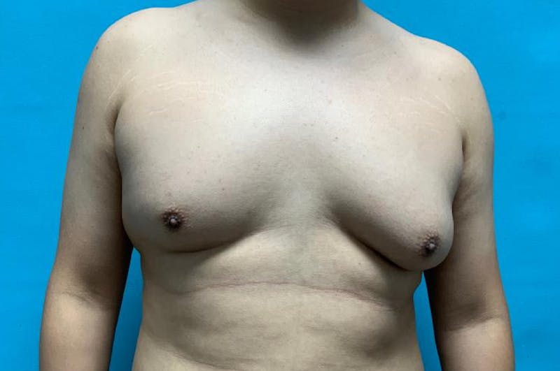 Gynecomastia Before & After Gallery - Patient 8795164 - Image 1