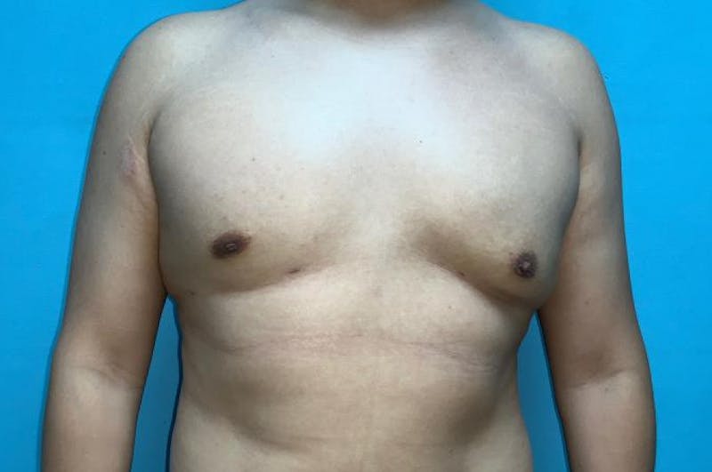 Gynecomastia Before & After Gallery - Patient 8795164 - Image 2